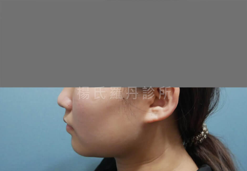 雷射減脂 瘦下巴